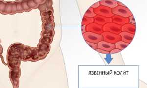 Симптомы язвы прямой кишки, лечение и профилактика