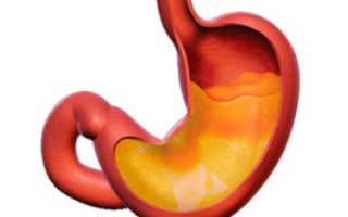 Что такое атрофический гастрит и его особенности