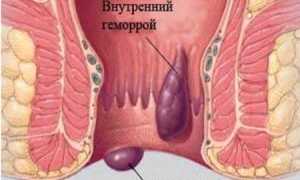 Симптомы геморроя у мужчин: важные аспекты здоровья