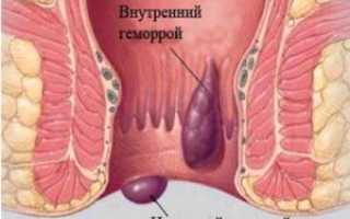 Симптомы геморроя у мужчин: важные аспекты здоровья
