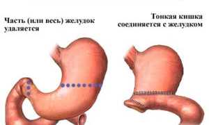 Диета после оперирования язвы желудка: рекомендации и советы
