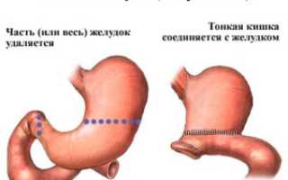 Диета после оперирования язвы желудка: рекомендации и советы