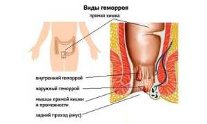 Лечение наружного геморроя в домашних условиях: советы и рекомендации
