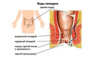 Лечение наружного геморроя в домашних условиях: советы и рекомендации