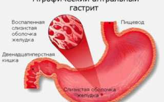 Диетическое питание при атрофическом гастрите для здоровья