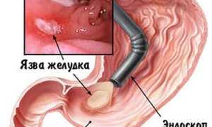 Гастроскопия и эзофагогастродуоденоскопия: есть ли разница в процедурах?