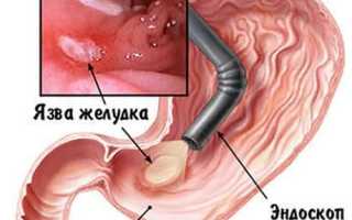Гастроскопия и эзофагогастродуоденоскопия: есть ли разница в процедурах?