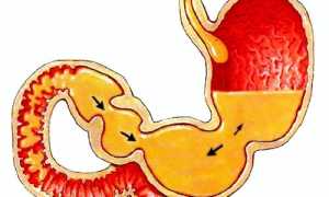 Рефлюкс гастрит билиарный: причины и лечение