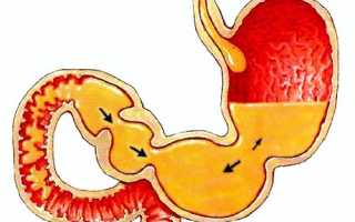 Рефлюкс гастрит билиарный: причины и лечение
