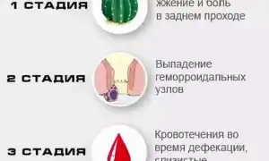 Зуд и жжение при геморрое: причины и лечение