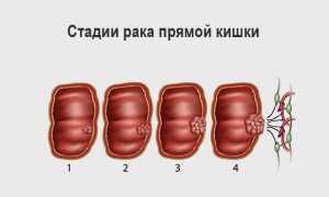 Переходит ли геморрой в рак: важные аспекты и факты