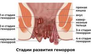 Как самому вправить геморрой в домашних условиях безопасно и эффективно
