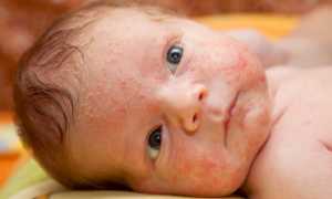 Жидкий стул у ребенка при грудном вскармливании: причины и рекомендации