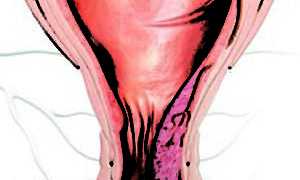 Воспаление узлов при геморрое: причины и лечение
