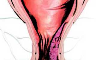 Воспаление узлов при геморрое: причины и лечение