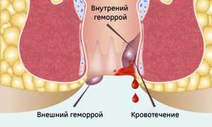 Геморрой хронический: причины и лечение