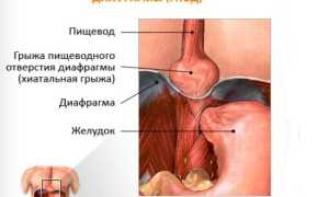 Диетическое питание при рефлюксе-эзофагите для здоровья