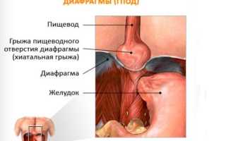 Диетическое питание при рефлюксе-эзофагите для здоровья