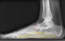 Рентген стоп с нагрузкой (выявление плоскостопия)