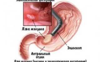 Фиброгастроскопия: что это, зачем нужна, что показывает и как проходит