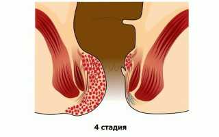 Стадии развития геморроя: основные этапы и симптомы
