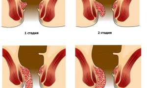 Геморрой после родов: причины и лечение