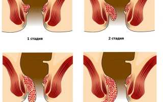 Геморрой после родов: причины и лечение