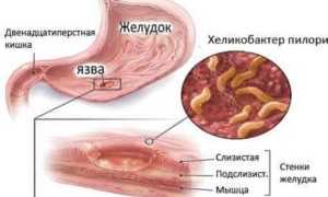 Язва в желудке: причины и лечение