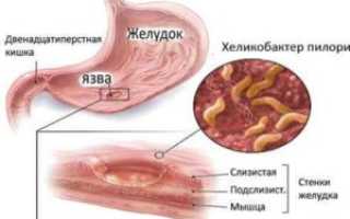 Язва в желудке: причины и лечение