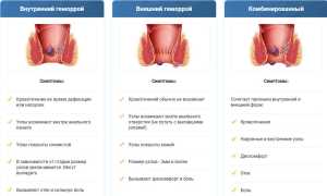 Симптомы появления геморроя и их особенности