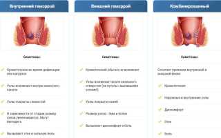 Симптомы появления геморроя и их особенности
