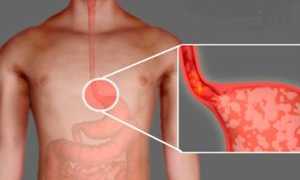 Причины изжоги и последствия для здоровья