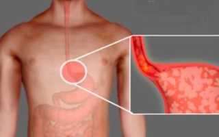 Причины изжоги и последствия для здоровья