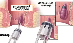 Лигирование узлов геморроя латексными кольцами: эффективный метод лечения
