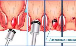 Какие врачи лечат от геморроя и как выбрать специалиста