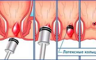 Какие врачи лечат от геморроя и как выбрать специалиста