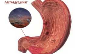 Хроническая форма гастродуоденита: симптомы и лечение