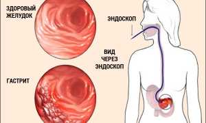 Признаки гастрита и язвы желудка, отличия и советы по лечению