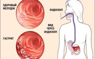 Признаки гастрита и язвы желудка, отличия и советы по лечению
