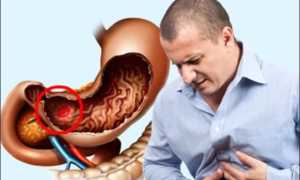 Язва в антральном отделе желудка: причины и лечение