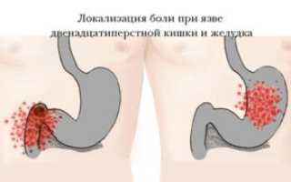 Симптомы и лечение язвы 12-перстной кишки: важные аспекты здоровья