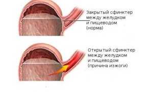 Изжога у беременных: причины и способы облегчения