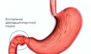 Что такое бульбит желудка и его симптомы