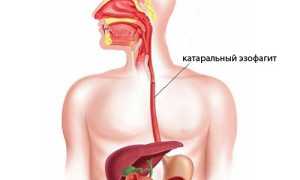 Эзофагит катаральный: причины и симптомы