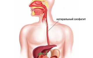 Эзофагит катаральный: причины и симптомы