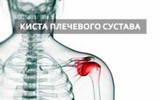 Киста плечевого сустава: причины, симптомы и лечение