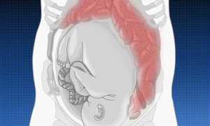 Запор у женщин после кесарева сечения: причины и лечение
