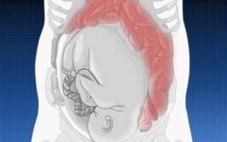 Запор у женщин после кесарева сечения: причины и лечение