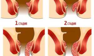 Сколько времени лечится геморрой у взрослых пациентов