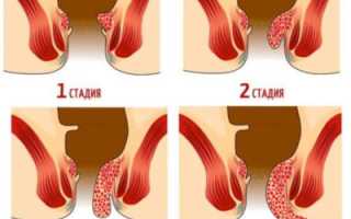 Сколько времени лечится геморрой у взрослых пациентов